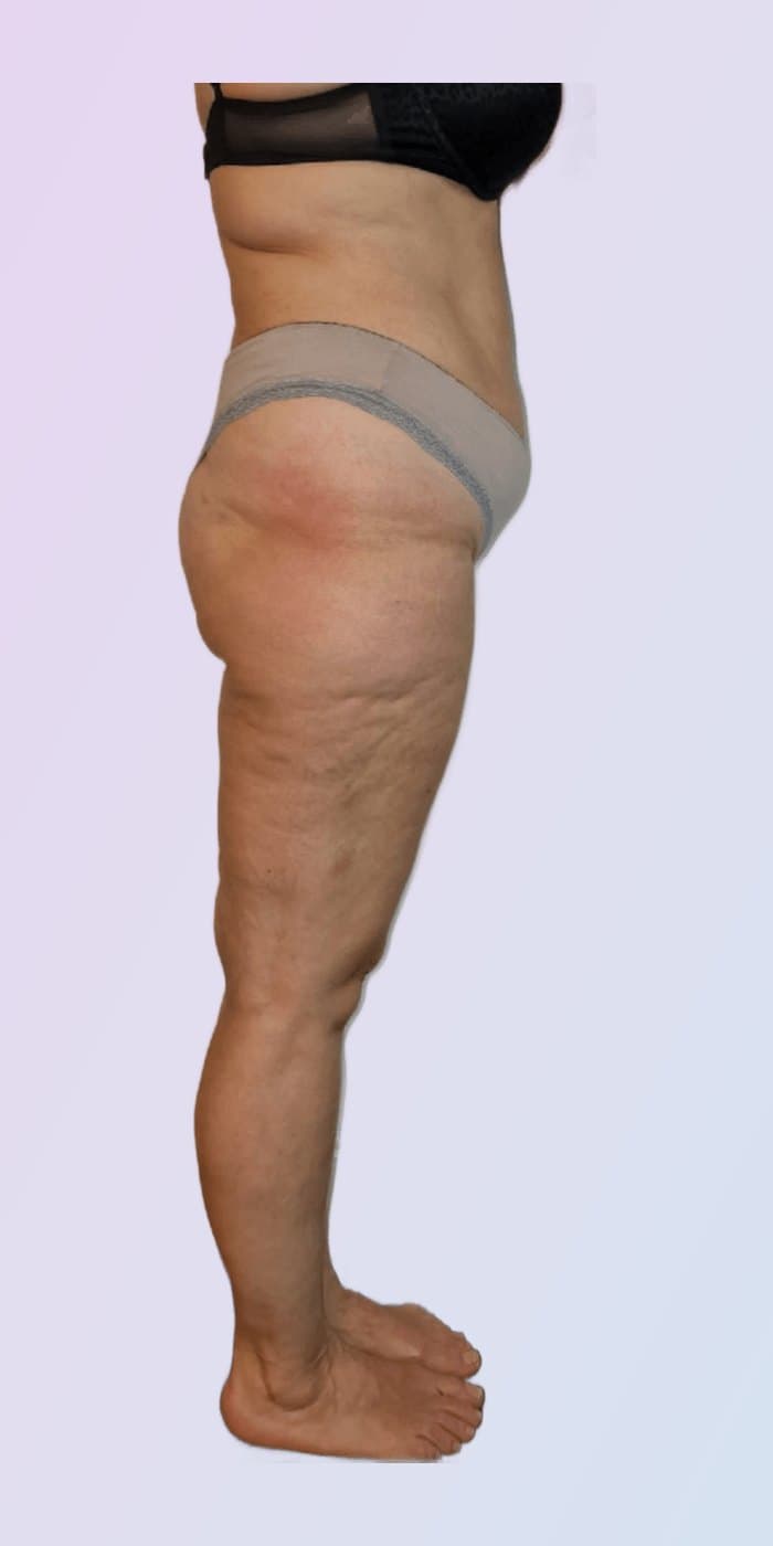Vorher-Nachher — Taille & Oberschenkel · Seitenansicht — nachher