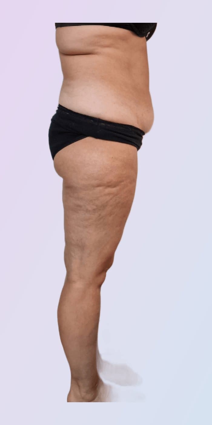 Vorher-Nachher — Taille & Oberschenkel · Seitenansicht — vorher
